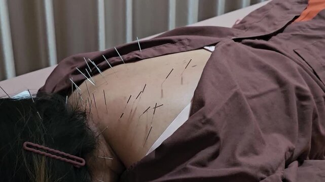 An Asian woman lying face down on her back receiving acupuncture, alleviating back pain and treating muscle injuries. Office Syndrome