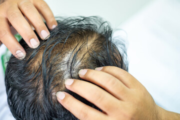 Both of the man's hands grabbed his hair to show off the sparse hair. man’s scalp with visible...