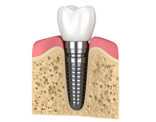 Obraz premium Single Tooth Implant Model with Screw and Crown, Side Cutaway View