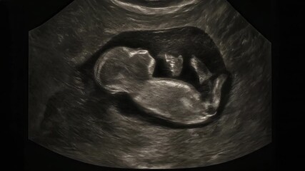 Sonogram of Baby