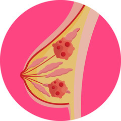 Breast cancer awareness emblem used to promote early detection and support.
