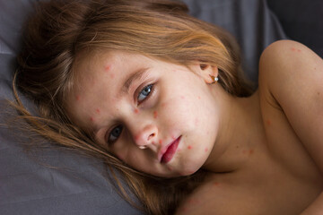 Little sad girl with a rash on her face and body lies in bed with a toy, chickenpox or measles...
