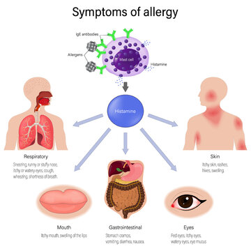 Symptoms of allergy. Symptoms can occur in the respiratory system, skin, digestive system, mouth, and eyes. Mechanism of allergy. Allergens, antibodies and Mast cell. Human immune system. 