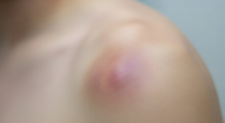 Fototapeta premium Close-up of a person's shoulder with a visible bruise or swelling indicating injury or medical condition in a clinical setting for healthcare or medical treatment concepts