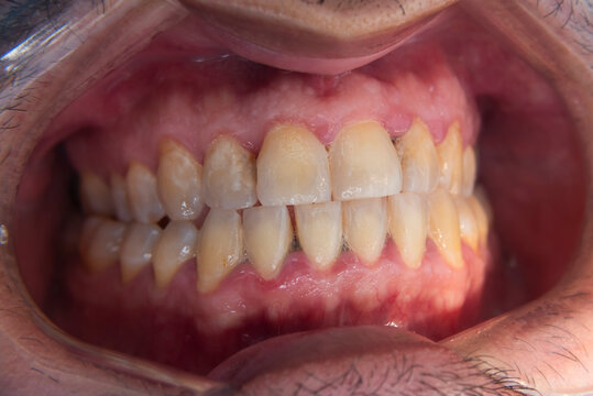Macro dental photos showing plaque accumulation, mild enamel demineralization, and anterior crowding in adult male patient&rsquo;s teeth, prior to oral prophylaxis.