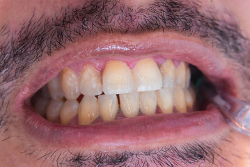 Macro dental photos showing plaque accumulation, mild enamel demineralization, and anterior...