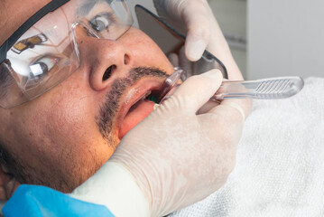Close-up of a nervous dental patient in safety glasses during an oral checkup using a cheek...