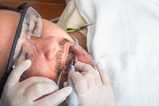 Detailed view of a dental professional using an ultrasonic scaler and mirror during oral prophylaxis on a reclining patient.
