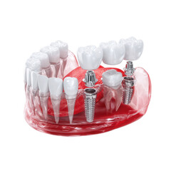3D model of human jaw with two dental implants supporting a bridge of crowns