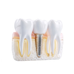 Dental implant illustration