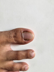 Close-up of male toes with dry skin and uncut nails on white background. foot health and hygiene awareness
