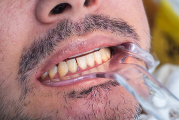 A plastic cheek retractor is used to reveal the patient's teeth and gums during a dental...