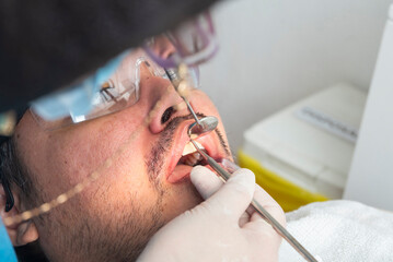 A dentist uses a stainless steel hand scaler and mirror to remove plaque from a patient's teeth...