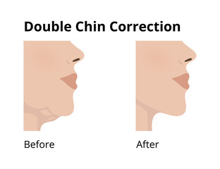 Woman face profile showing double chin correction, before and after