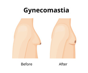 Gynecomastia surgery showing male chest before and after