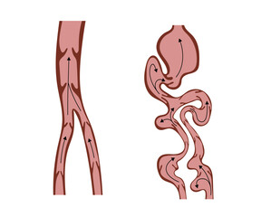 Normal Veins and Varicose Veins Showing Blood Flow