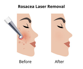 Laser removing rosacea couperose on woman face before and after procedure