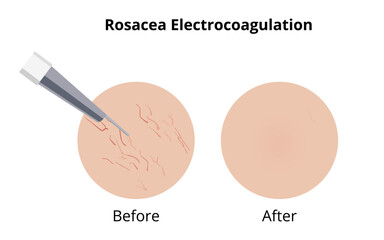 Electrocoagulation removing rosacea couperose veins before and after treatment
