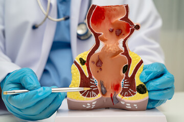 Asian doctor with rectum and hemorrhoid human anatomy model at hospital, inflamed vascular...