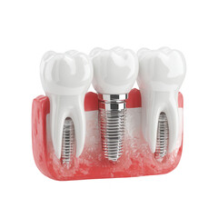 Dental implants, teeth, gums, jawbone