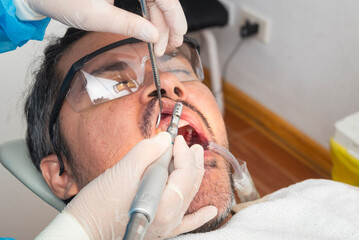 Close-up of a dental hygienist polishing teeth with a prophy angle and mirror during the final stage of oral prophylaxis.