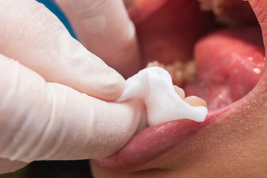 Dental professional wipes the patient's gums and lower lip with gauze after oral prophylaxis to remove debris and excess paste.