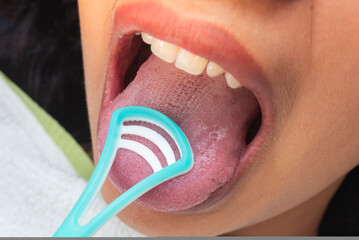 A tongue scraper is used on the surface of the tongue to remove bacteria buildup and improve oral hygiene and breath.