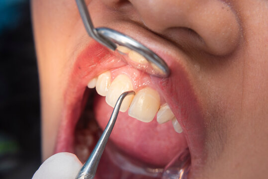 Detailed view of a dental professional scaling plaque from upper front teeth and incisors using a manual scaler and mouth mirror for cleaning.