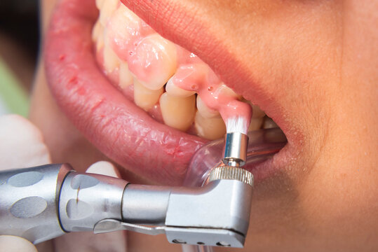 Closeup of dental hygienist using prophy angle handpiece with rubber cup to polish teeth near the gumline for plaque removal.
