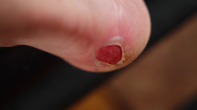 Zoomed-in of a red blister on person&rsquo;s heel due to rubbing from shoes