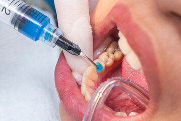Close-up of blue dental etchant being applied to a lower premolar to prepare enamel and dentin for...