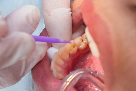 Dentist applies yellow bonding agent to conditioned lower premolar using microbrush before placing composite filling material.
