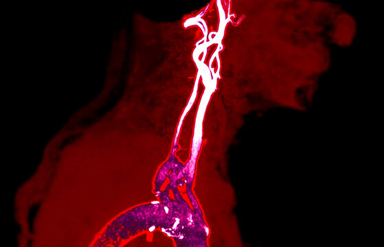 Vivid MRA scan reveals symmetrical flow of blood through the neck's main arteries with dramatic contrast.