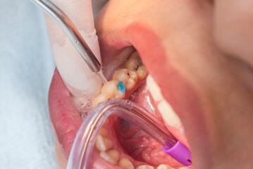 Dental assistant rinses blue etchant from lower premolar after enamel conditioning, part of cavity...