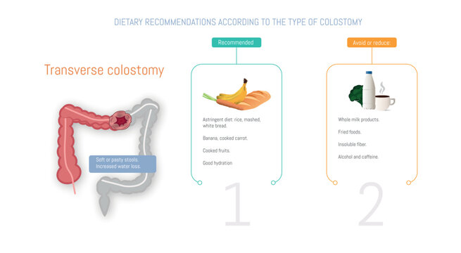 รูปภาพColostomy – เลือกดูภาพถ่ายสต็อก เวกเตอร์ และวิดีโอ1,450 | Adobe Stock