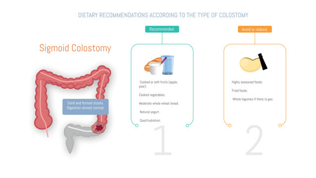 Dietary recommendations for sigmoid colostomy patients