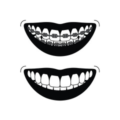 Naklejka premium Comparison of smiling mouth with and without dental braces