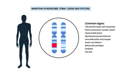 Marfan syndrome poster