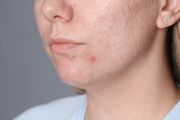 Fototapeta premium Woman with acne problem on grey background, closeup