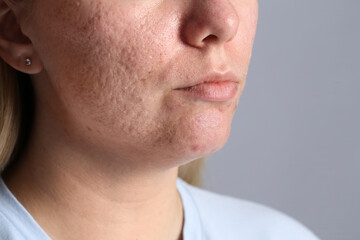 Fototapeta premium Woman with acne problem on grey background, closeup. Space for text