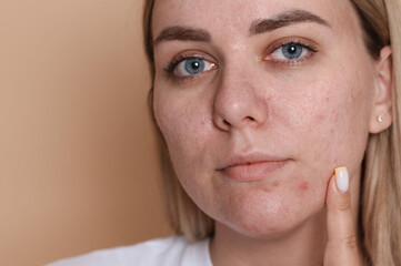 Woman with acne problem on beige background, space for text