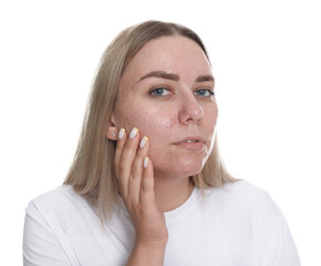 Woman with acne problem on white background