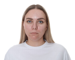 Woman with acne problem on white background