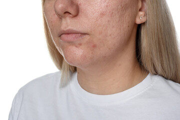Woman with acne problem on white background, closeup