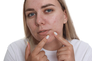 Woman popping pimple on white background. Acne problem