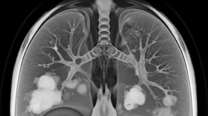 Detailed medical imaging scan showing human lungs with multiple large tumors indicating advanced cancer or serious respiratory disease for health and research - Powered by Adobe