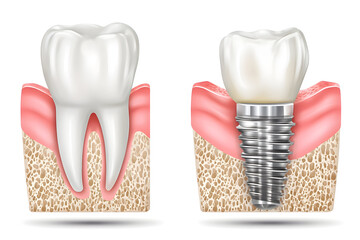 Detailed comparison of natural tooth structure and dental implant design illustrating the restoration process in dental care