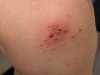 Close-up of scraped injured knee with fresh wound and abrasions on skin