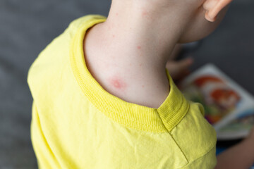 Little child with infection on the neck caused by insect, mosquito or bee bites.