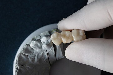 Close-up top view of dental cast with quartz dental bridge spanning teeth 5 to 7, held by two fingers in white gloves. Dental prosthetics and lab work concept on dark background.
